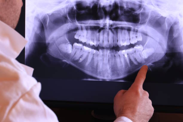 Best Knocked-Out Tooth (Avulsed Tooth) Treatment in Fort Washington, PA